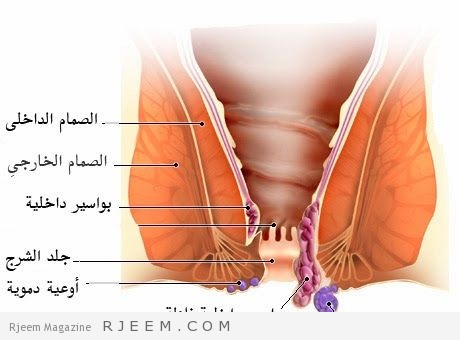 اعراض البواسير وعلاجها , البواسير اعراضها وعلاجاتها بالليزر