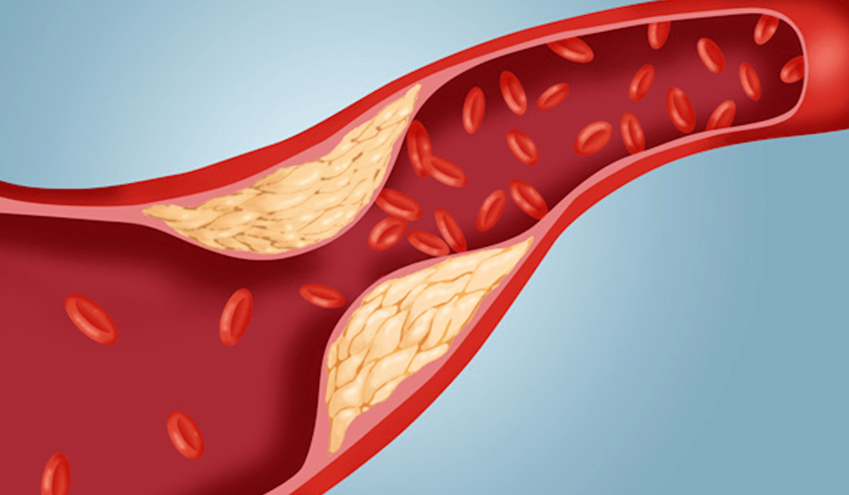 اعراض الكولسترول المرتفع - بسبب كتير من المشاكل هقلك عليه 3495