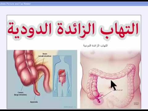 اعراض المصران الاعور - او ما يسمي بالزايده الدوديه 2156