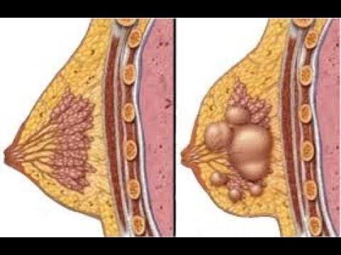 الاورام الحميدة في الثدي بالصور - معلومه لا تعرفها عن سرطان الثدى الحميد 1009 10