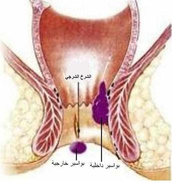 كم تستغرق عملية الشرخ - تفاصيل مهمه عن الشرخ الشرجى 274 1