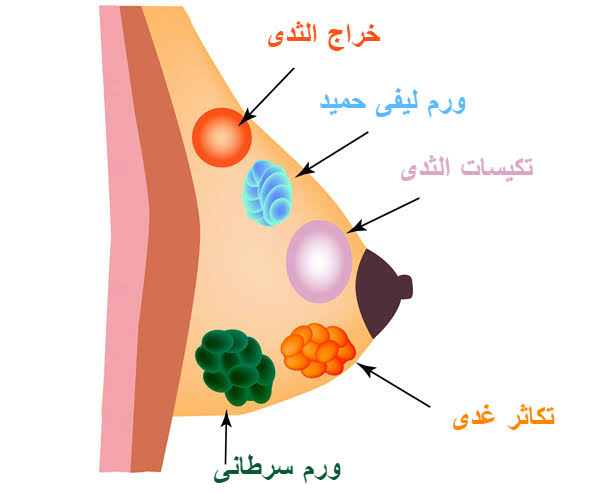 الاورام الحميدة في الثدي بالصور - معلومه لا تعرفها عن سرطان الثدى الحميد 1009 3