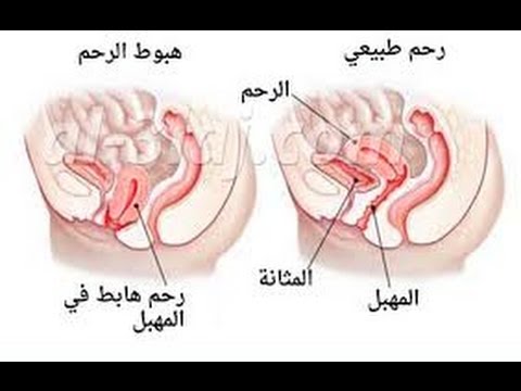 شكل الرحم النازل - نزول الرحم واشكاله المختلفه