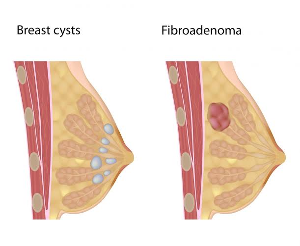 الاورام الحميدة في الثدي بالصور - معلومه لا تعرفها عن سرطان الثدى الحميد 1009 2