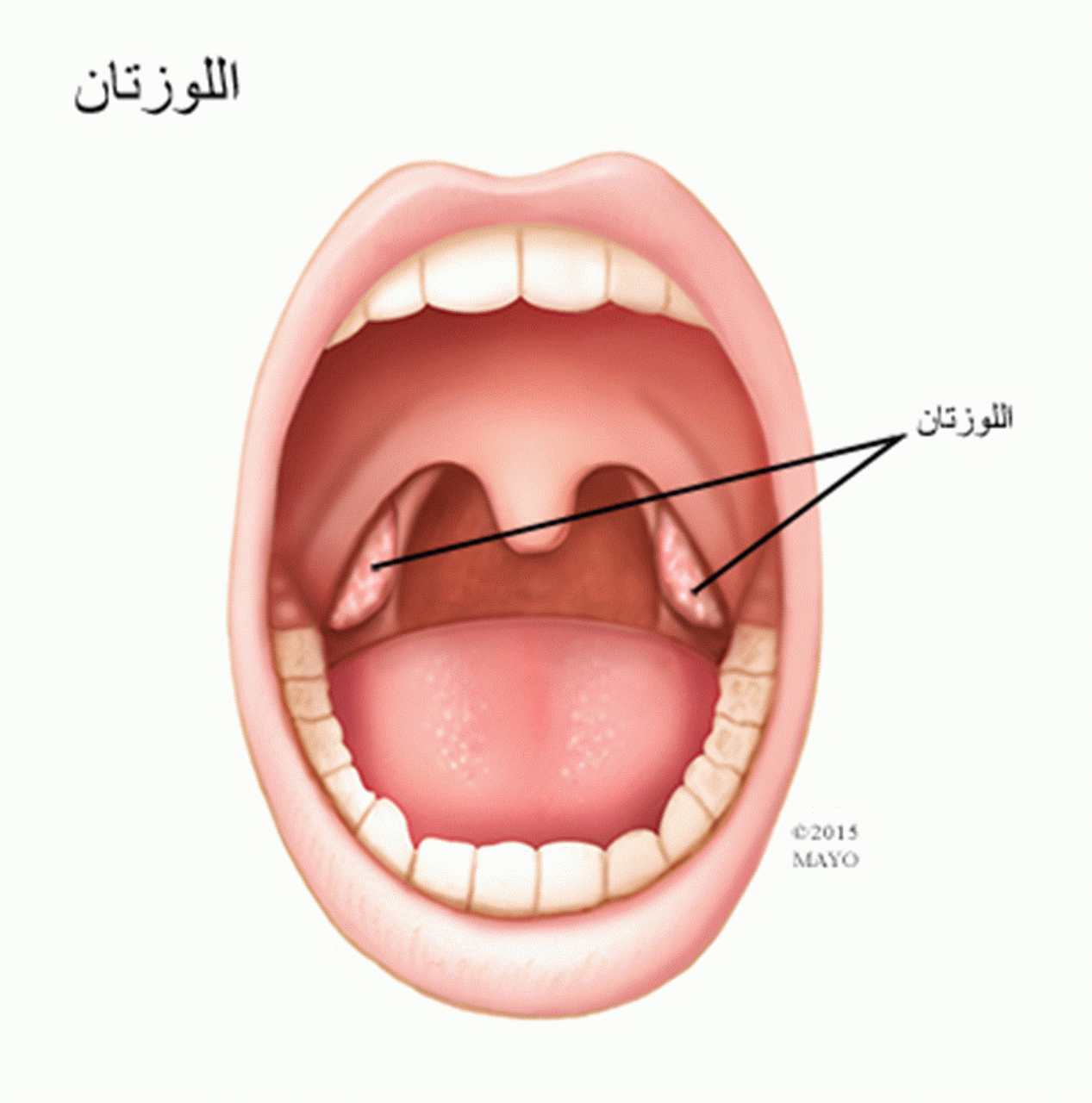 تضخم اللوزتين بدون الم , اعراض تضخم اللوزتين