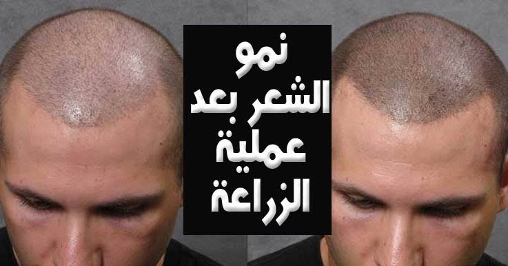 تكلفة زراعة الشعر في ادمه - الحل النهائي لمشاكل الشعر