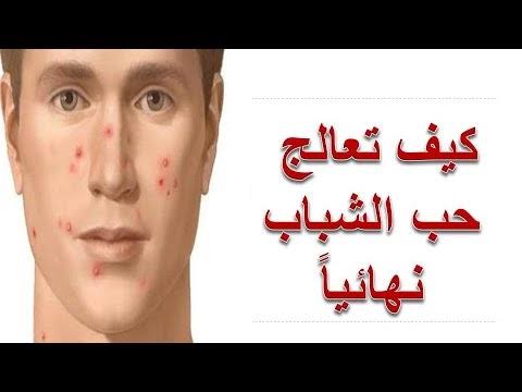 علاج حب الشباب - اسبابه وعلاجه 1501 2