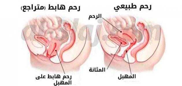 شكل الرحم النازل - نزول الرحم واشكاله المختلفه 2642 1