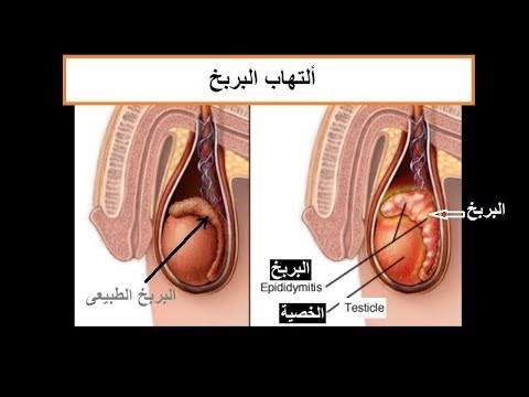 مدة علاج التهاب البربخ , اسبابه و مده العلاج