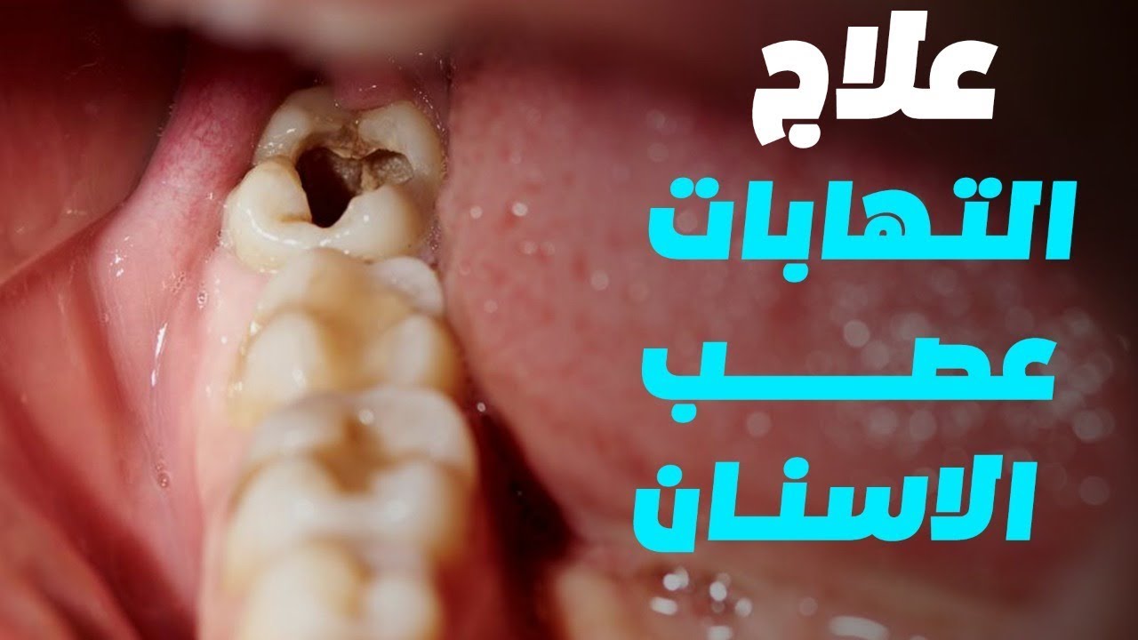 علاج اعصاب الاسنان ، كيفيه تجنب ألم الاسنان 6216 3