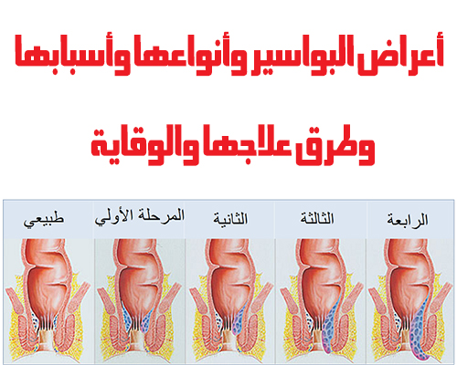 اعراض البواسير وعلاجها - البواسير اعراضها وعلاجاتها بالليزر 2560 2