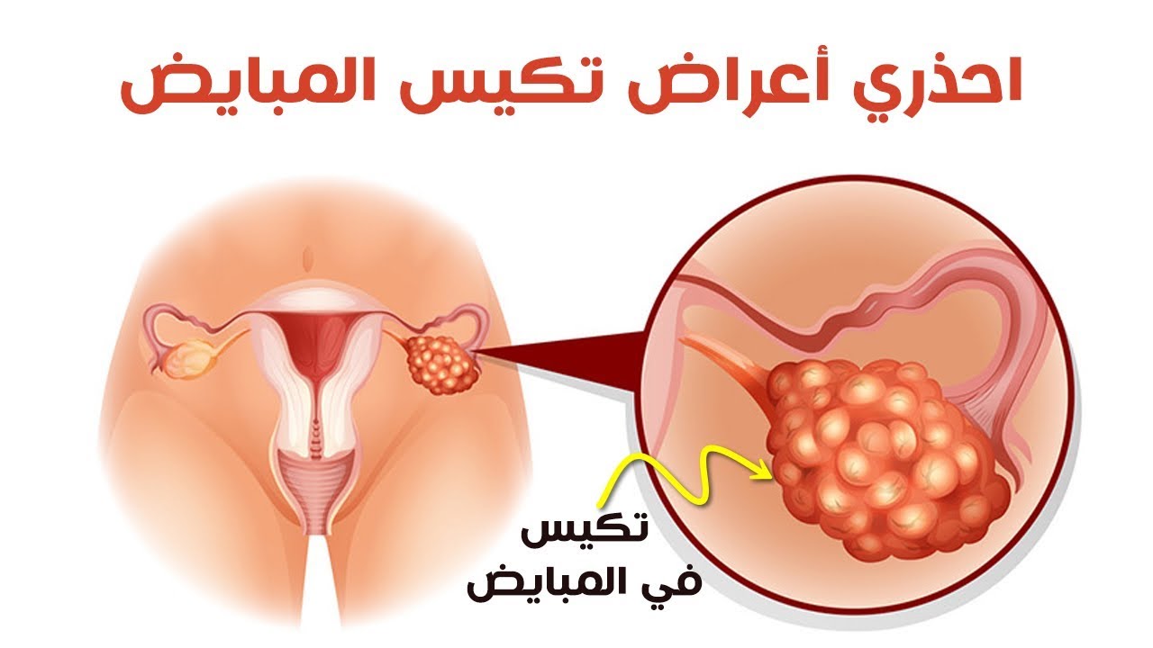 اضرار تكيس المبايض - اضرارها التى لا تعرفها 1399