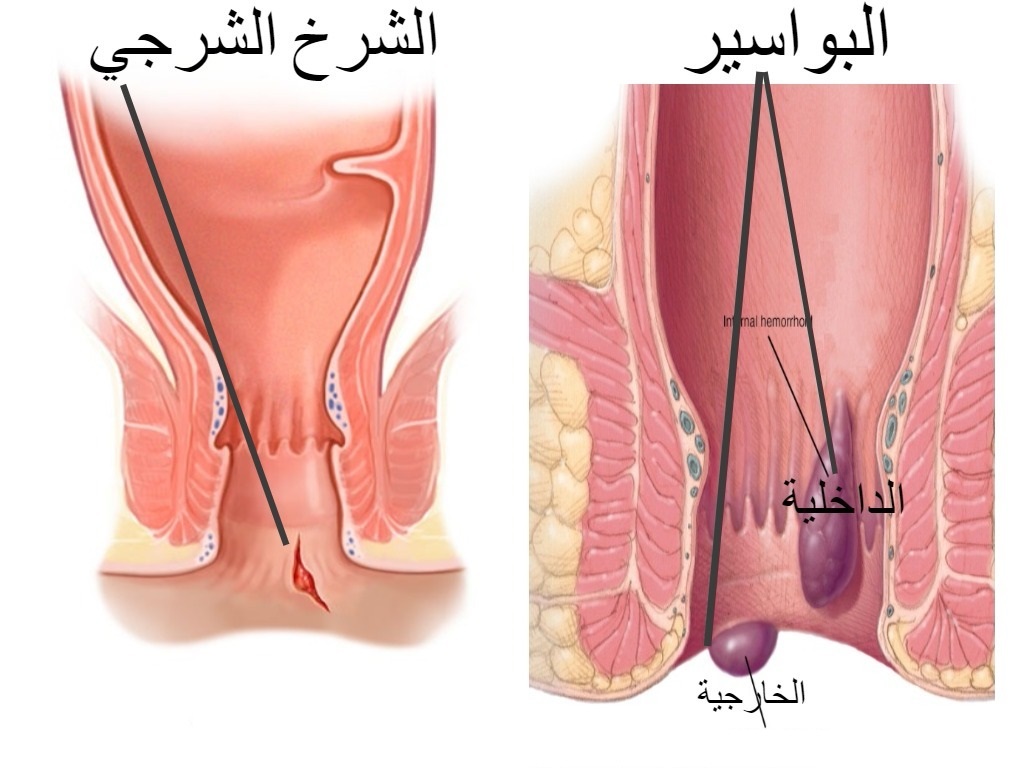 اعراض البواسير بالصور ، حتى لا تصاب بالبواسير 2670