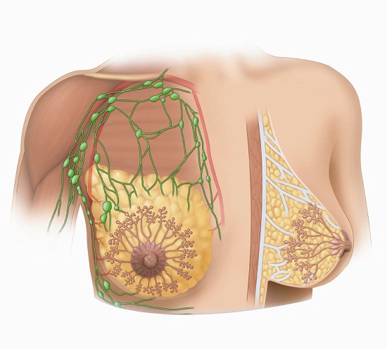 الاورام الحميدة في الثدي بالصور - معلومه لا تعرفها عن سرطان الثدى الحميد 1009