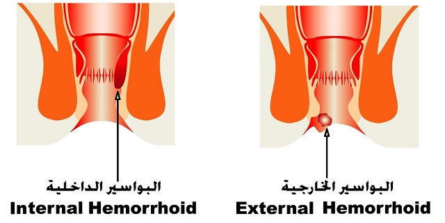 اعراض البواسير وعلاجها - البواسير اعراضها وعلاجاتها بالليزر 2560 1