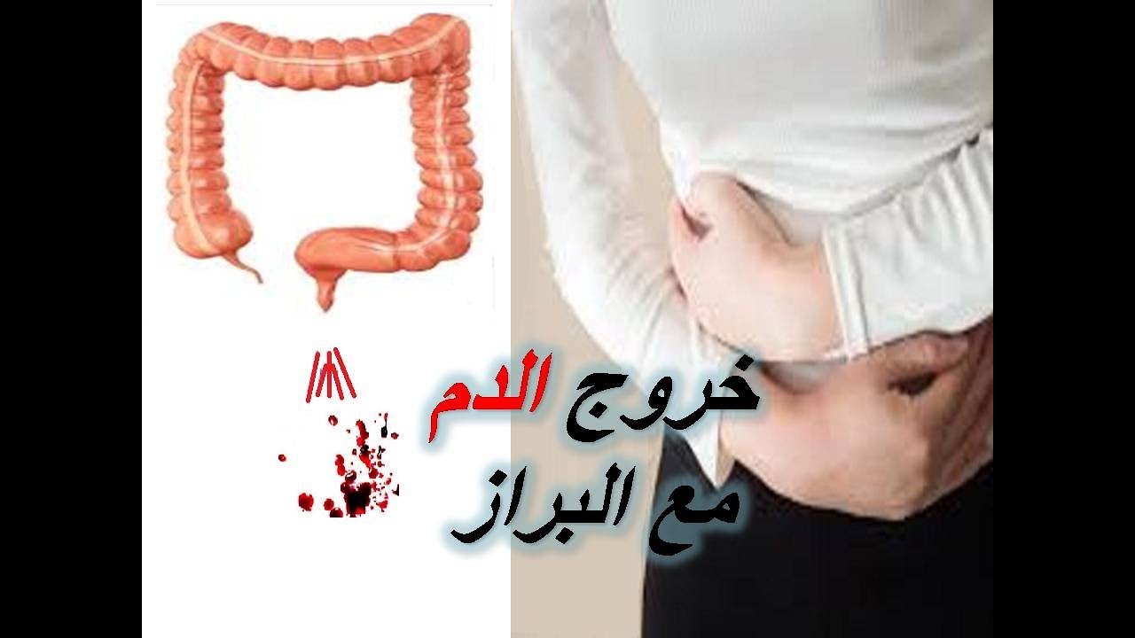 خروج الدم من الدبر ، الاسباب وطرق العلاج 6205