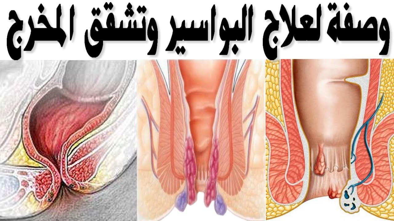 اعراض البواسير بالصور ، حتى لا تصاب بالبواسير 2670 1