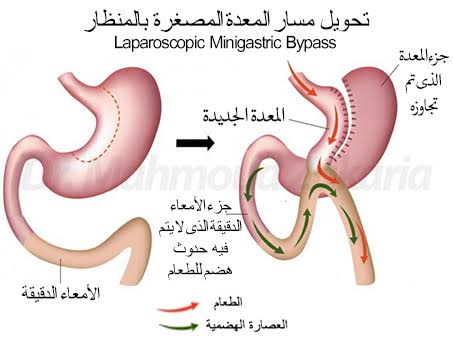 عملية تغيير مسار المعدة ، بدون رجيم تخلص من وزنك الزائد 849 2