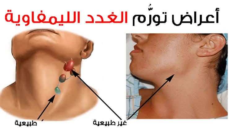 اعراض سرطان الغدد اللمفاوية - نوعين من السرطان 1154 2