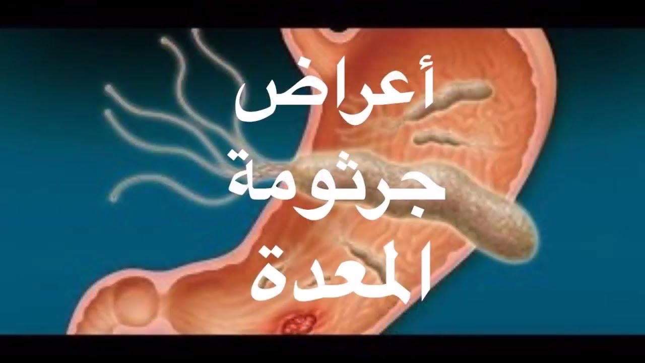 ماهي اعراض بكتيريا المعده - جرثومه المعده 1117 3