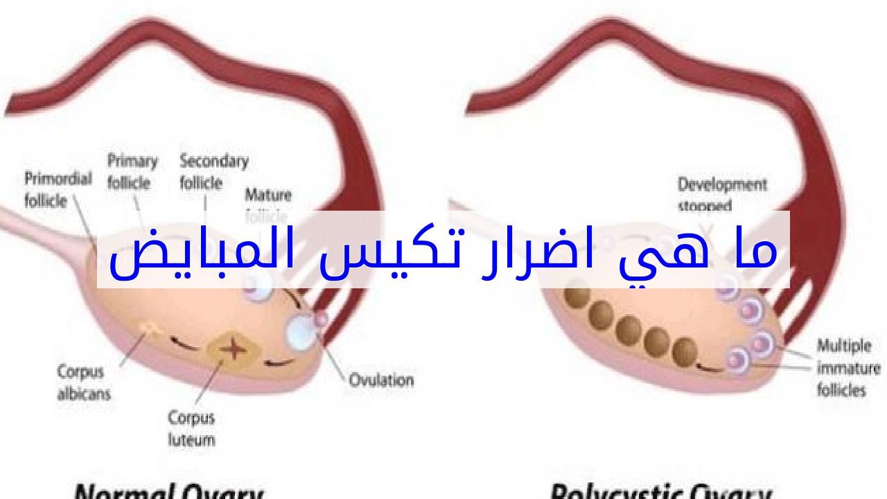 اضرار تكيس المبايض - اضرارها التى لا تعرفها 1399 1