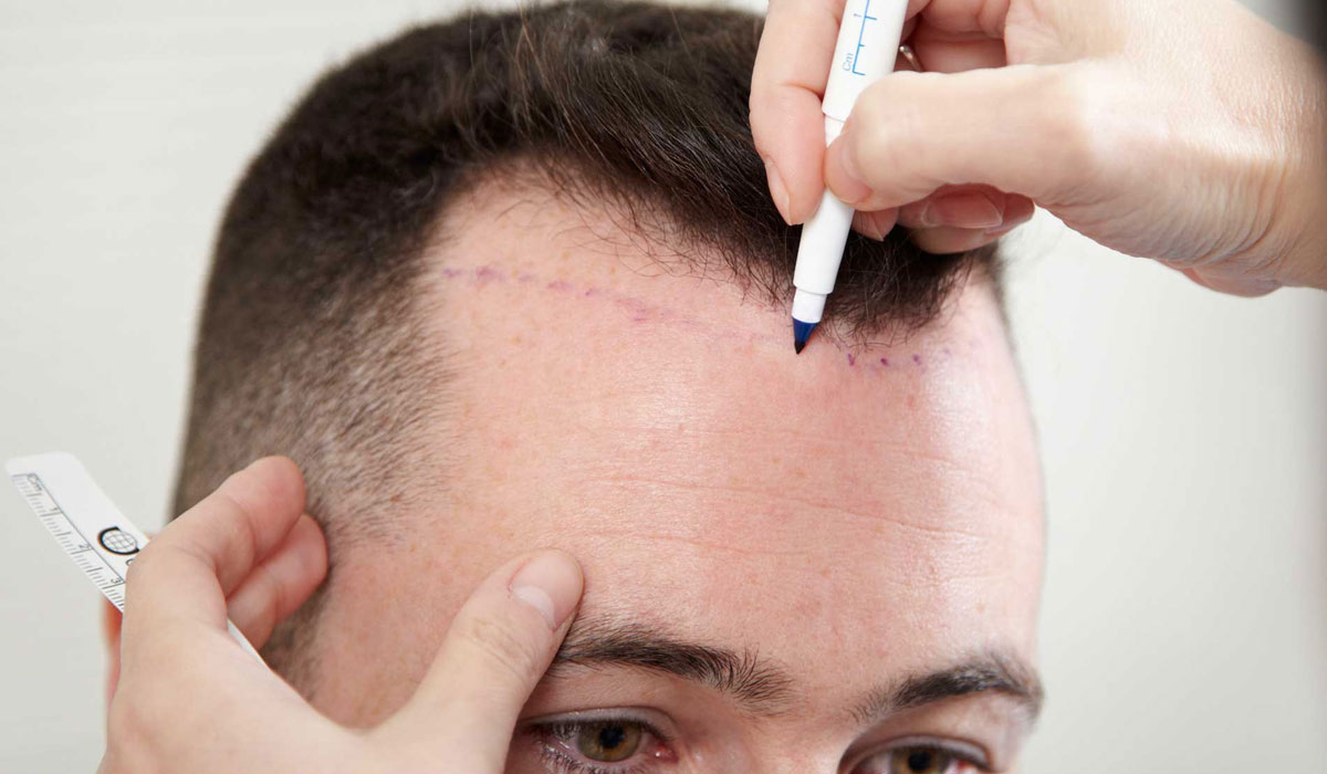 كم تكلفة زراعة الشعر في تركيا , اسعار منخفضة لشعر كثيف