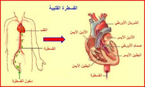 قسطرة القلب العلاجية , احذري اول علامات امراض القلب