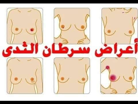 اعراض كانسر الثدى , اورام الثدي الخبيثه اسبابها واعرضها