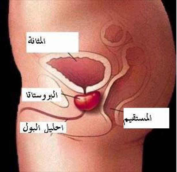 اعراض تضخم البروستاتا , التضخم الحميد للبروستاتا اعراضه وعلاجه