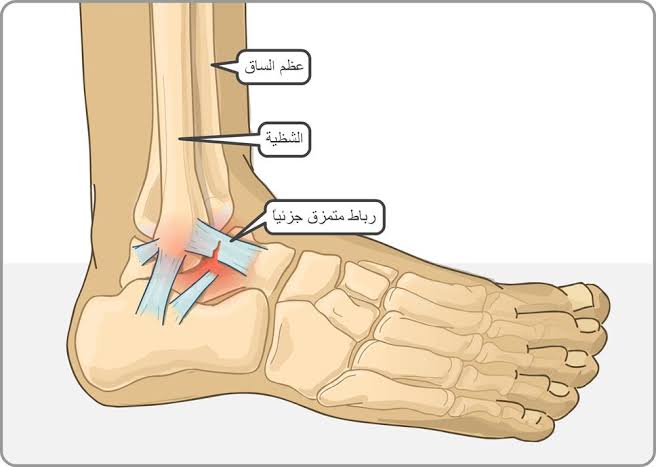 كم يستغرق علاج التواء الكاحل , اسبابه وطرق علاجه