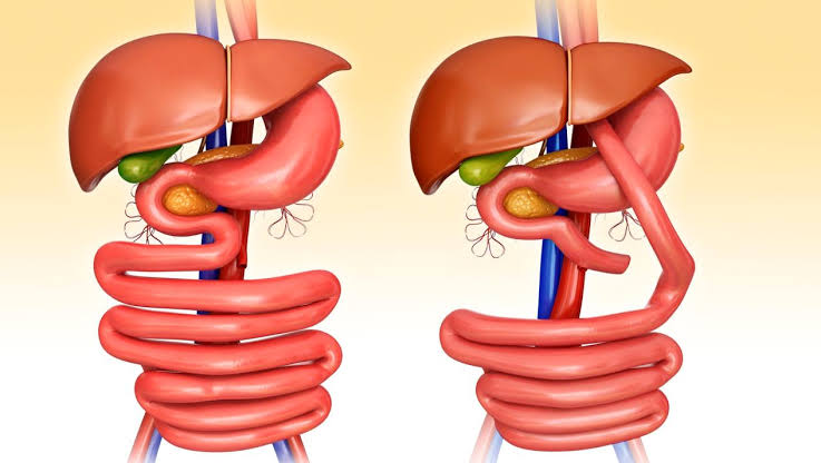 عملية تغيير مسار المعدة , بدون رجيم تخلص من وزنك الزائد