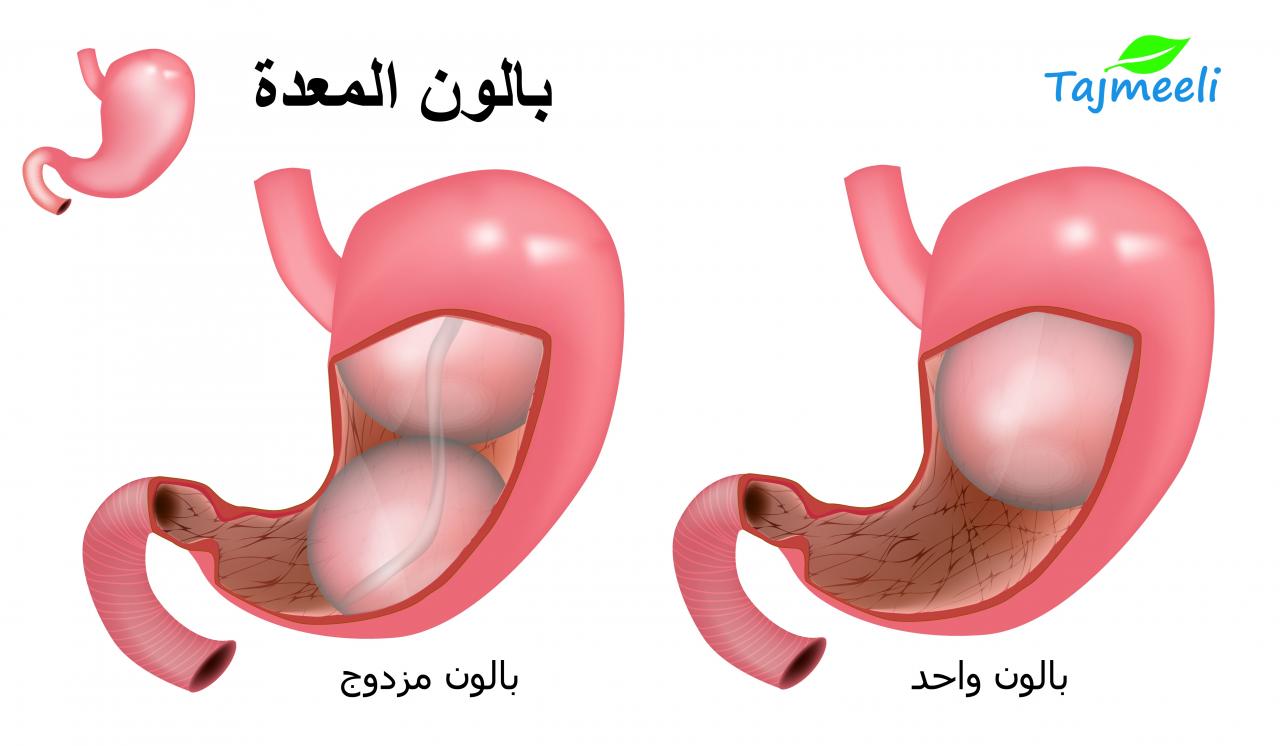 تجربتي مع كرمشة المعدة , كيفية علاج كرمشة المعدة , 